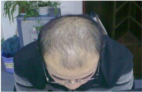 改善脱发问题只需要头部护理和黑尔霸生发仪
